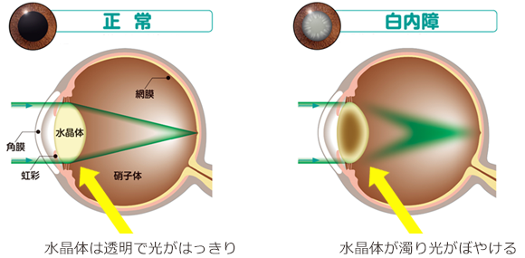 白内障とは