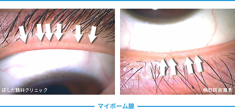 マイボーム腺